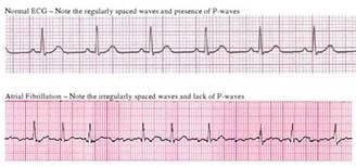 Atrial Flutter